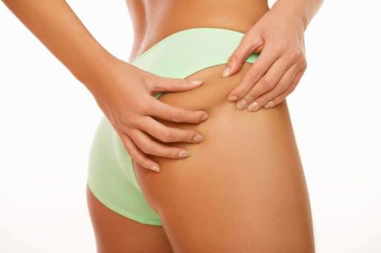 What is Cellulite? How is Cellulite Treated?